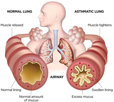 world asthma day    एही कारण से दमा के दौरा हो सकेला  जानी महत्वपूर्ण आ रोकथाम के उपाय